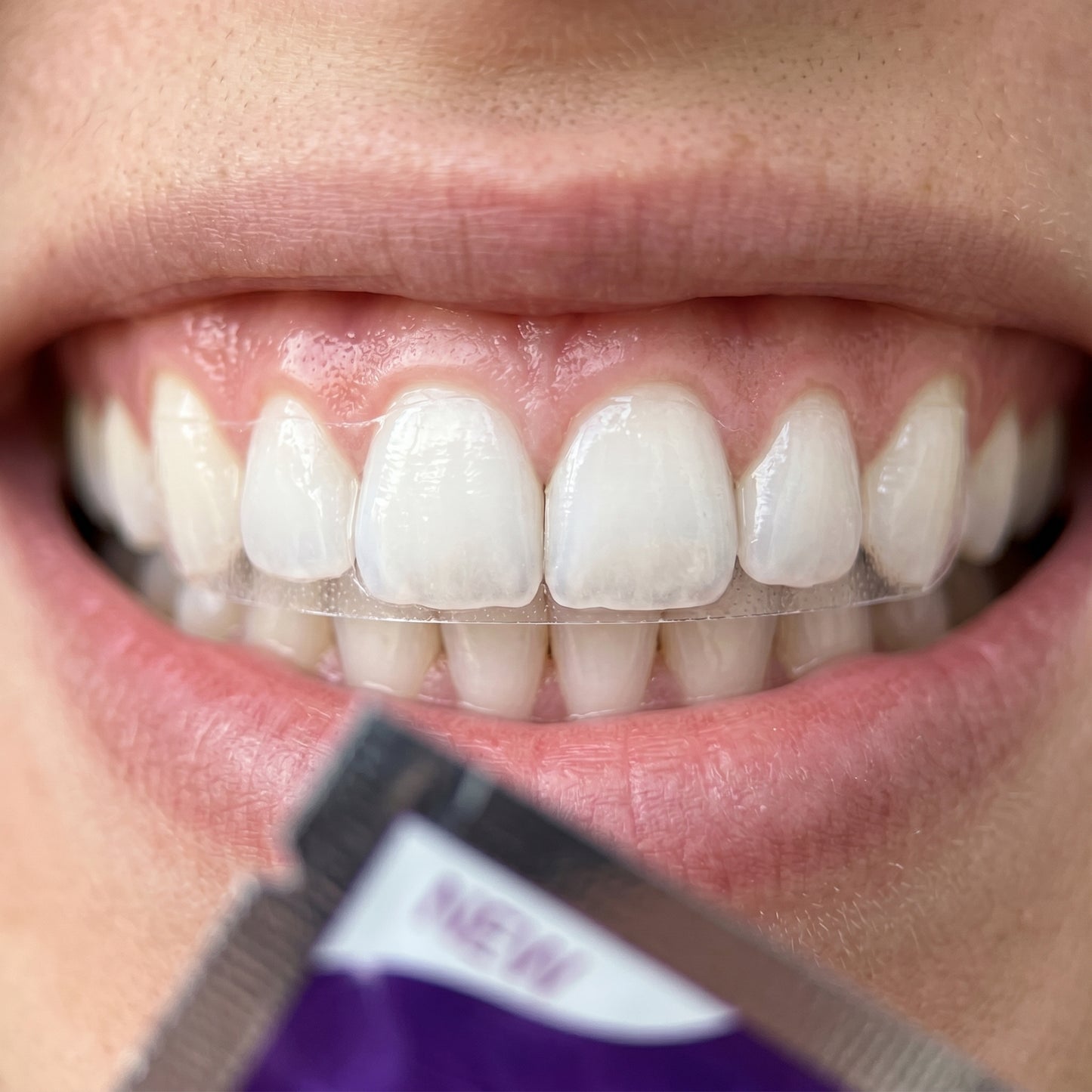 LUMI: Sonrisa de Diamante en 30 Minutos